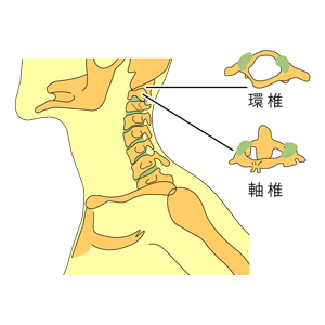 環椎と軸椎