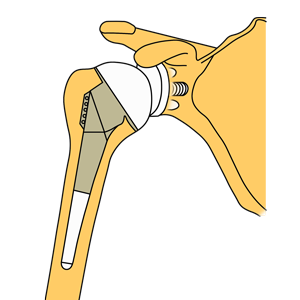 肩の人工関節